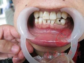 成人烂牙根治方法视频,成人烂牙根治方法深度解析