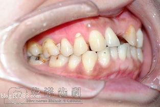 成人烂牙根治方法视频,成人烂牙根治方法深度解析