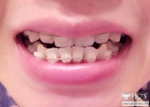 拔乳牙成人过程视频教程