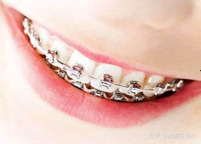 牙齿矫正自锁视频成人,成人矫正新体验，轻松实现完美笑容